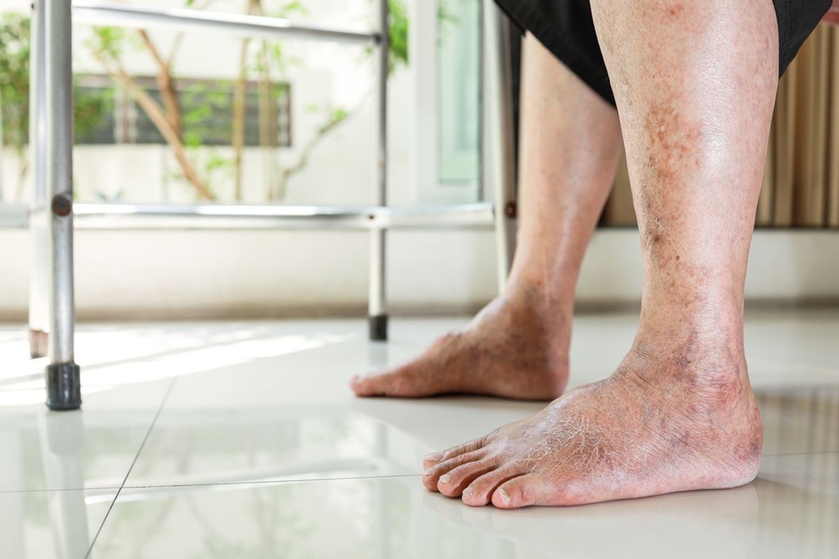 Pencegahan Diabetes yang Sudah Parah: Masih Ada Harapan!